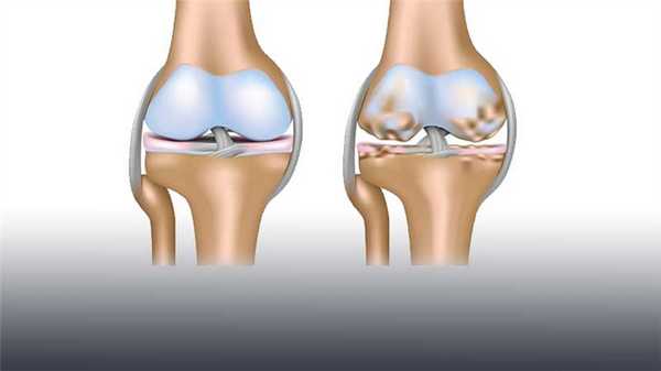 chto-takoe-sustavnaya-mysh-kolennogo-sustava-i-kak-ee-lechit3.jpg