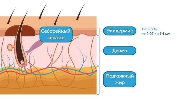 Структура кожи с образованием в пределах эпидермиса