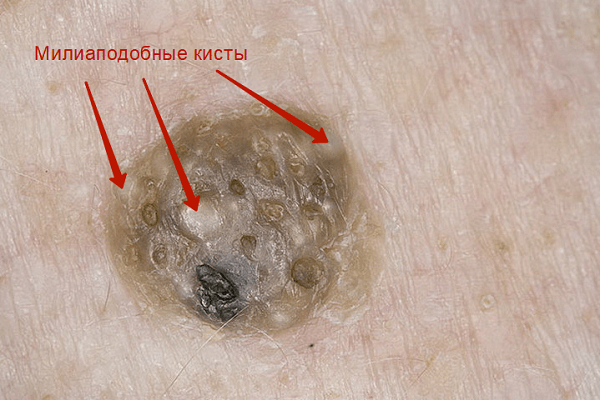 На фото - милиаподобные кисты на кератоме