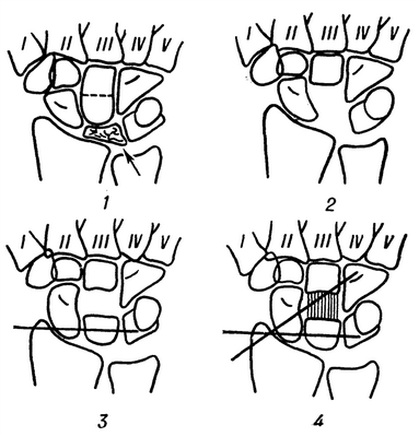 Рис. 4. Схема реконструктивной операции с перемещением головки головчатой кости и с частичным артродезом кистевого сустава (модификация операции Гранера): 1— пораженная полулунная кость указана стрелкой; уровень остеотомии головчатой кости показан пунктирной линией; 2— удалена полулунная кость, временно извлечена головка головчатой кости; 3—на место полулунной кости реплантирована головка головчатой кости и фиксирована спицей; 4— между фрагментами головчатой кости вставлен цилиндрический костный ауто-трансплантат (заштрихован), кистевой сустав фиксирован спицами.