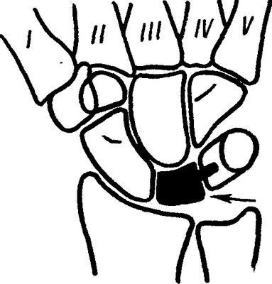 Рис. 3. Схема операции замещения удаленной полулунной кости силиконовым эндопротезом (по Свенсону): штифт протеза внедрен в трехгранную кость (протез указан стрелкой).