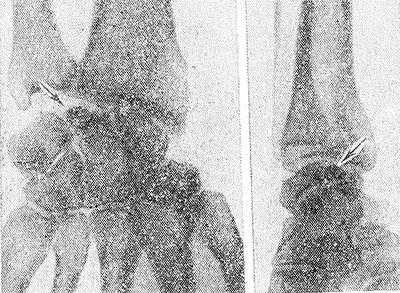 Рис. 1. Рентгенограммы кистевого сустава (слева в прямой проекции, справа — в боковой) при болезни Кинбека в стадии фрагментации: стрелками указана пораженная полулунная кость.