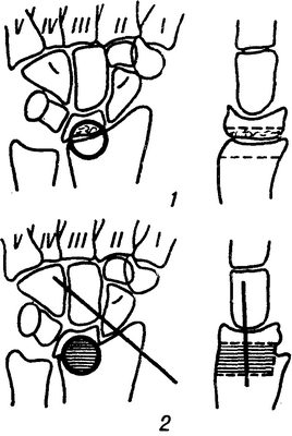 Рис. 2. Схема полулунно-лучевого артродеза цилиндрическим трансплантатом при частичном разрушении полулунной кости: 1— образование цилиндрического дефекта (очерченный круг) на стыке между пораженной полулунной и лучевой костями, справа — то же в боковой проекции (пунктиром обозначены границы дефекта); 2—в образованный дефект вставлен цилиндрический трансплантат (заштрихован); кистевой сустав фиксирован спицей, справа— боковая проекция.