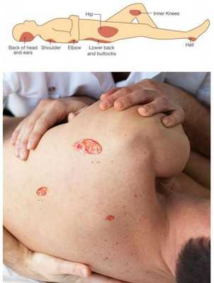 Пролежни и их локализация