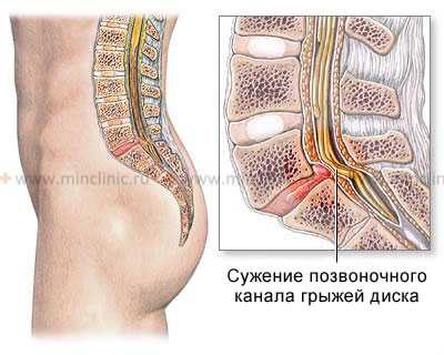 Смещение позвонков или спондилолистез позвоночника при его нестабильности со сдавлением нерва.