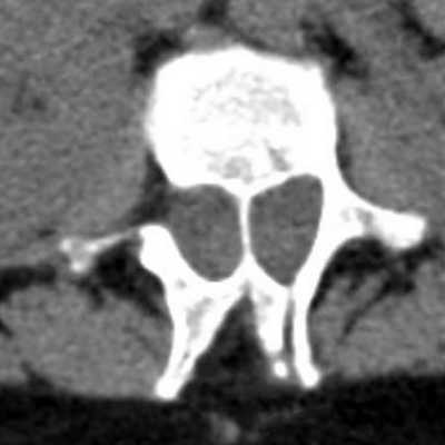 При диастематомиелии на компьютерной томографии позвоночника определяются расширенный позвоночный канал с разделяющей его костной перемычкой и расхождение краев костного дефекта дужки позвонка.