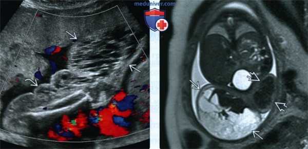 УЗИ, МРТ при синдроме Клиппеля-Треноне-Вебера у плода