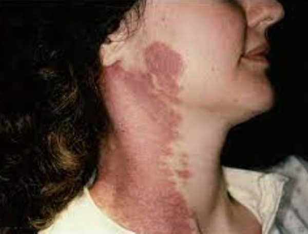 Синдром Клиппеля-Фейля