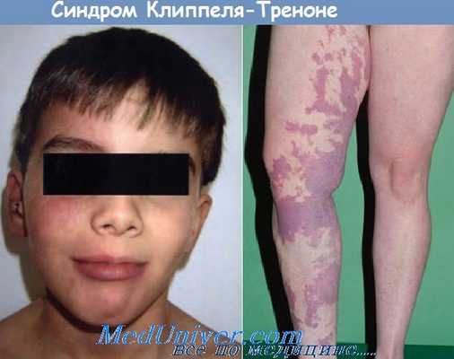 синдром Клиппеля-Треноне