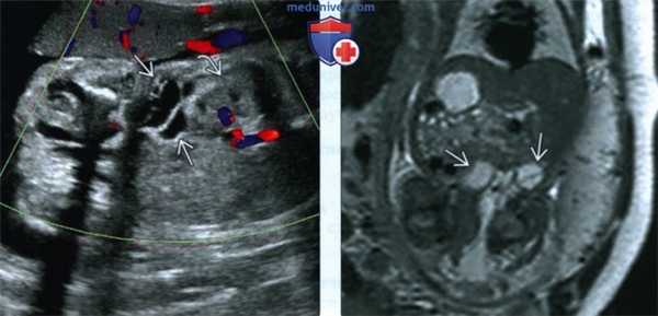 УЗИ, МРТ при синдроме Клиппеля-Треноне-Вебера у плода