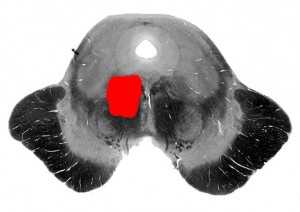 Клода-Луайе синдром_схема