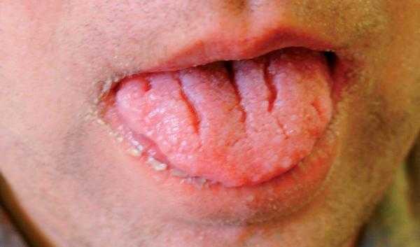 Синдром Коудена