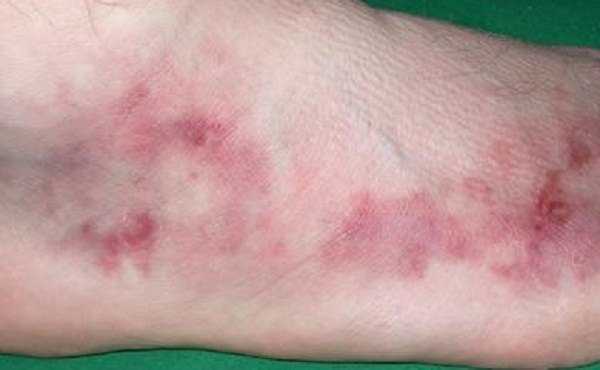 Проявление узелкового периартериита