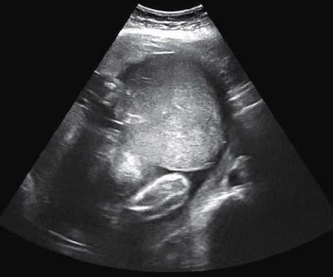 Матка Кувелера