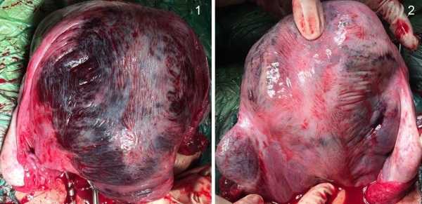 Матка Кувелера