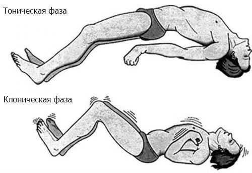 Тонико-клонические приступы