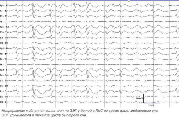 ЭЭГ во время фазы медленного сна у детей с ЛКС 