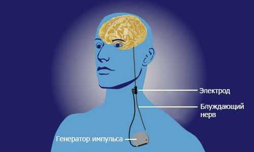Стимуляция блуждающего нерва