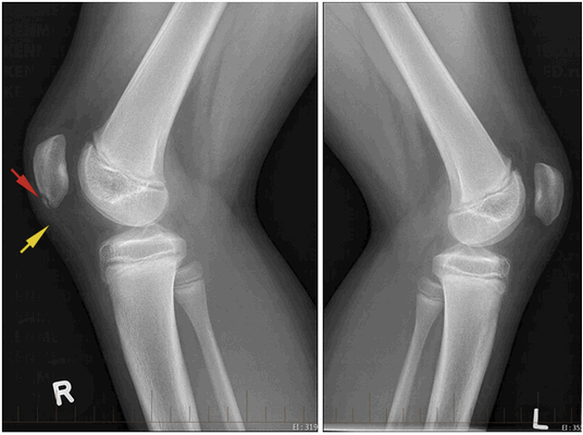 Болезнь Синдинга-Ларсена-Йоханссона