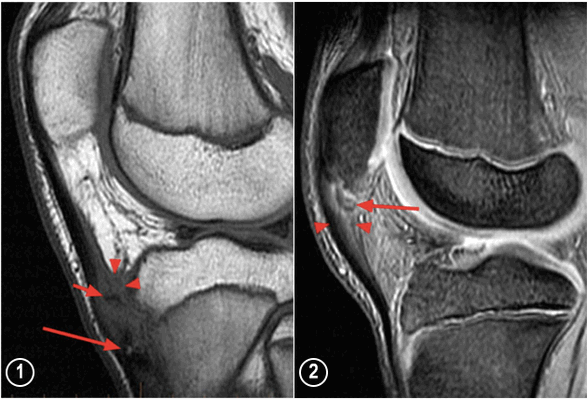 Болезнь Синдинга-Ларсена-Йоханссона