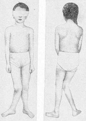 Вальгусная деформация нижних конечностей у ребенка с синдромом Лайтвуда — Олбрайта.