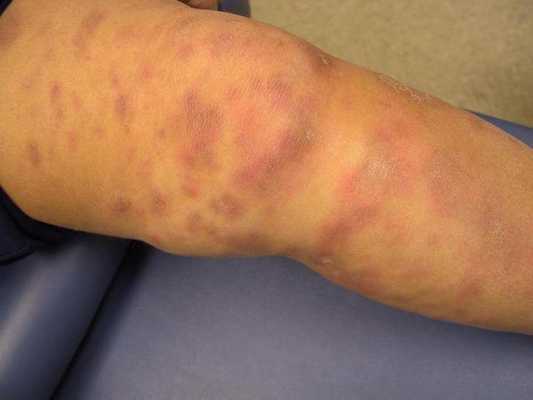 синдром лефгрена при саркоидозе проявляется