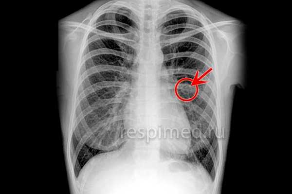 Как образуется киста