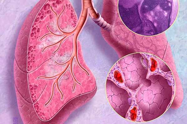 Саркоидоз и его лечение