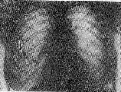 Рис. 1. Рентгенограмма грудной клетки больного с синдромом Леффлера: одиночный инфильтрат в правом легком (указан стрелкой).
