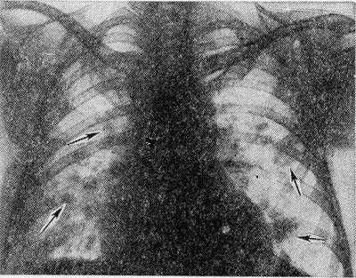 Рис. 2. Рентгенограмма грудной клетки больного с синдромом Леффлера: множественные двусторонние инфильтраты в легких (указаны стрелками).