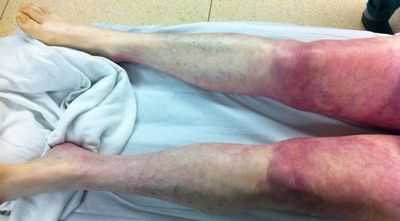 Поражение ног при Синдроме Лериша