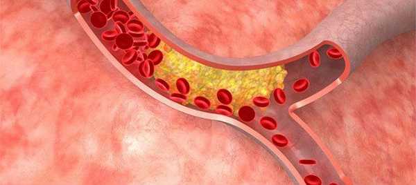 Образование тромба