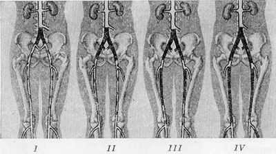 4 стадии заболевания