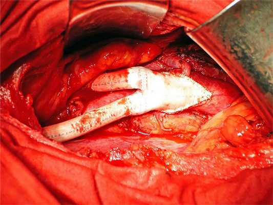 Операция на сосудах