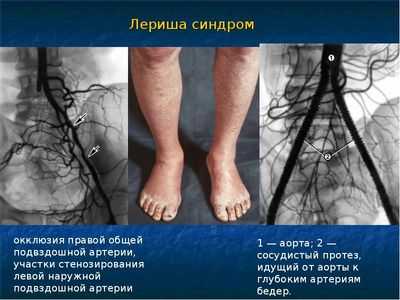 Синдром Лериша