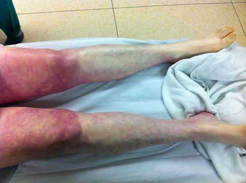 Синдром Лериша