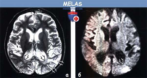 MELAS на МРТ головного мозга