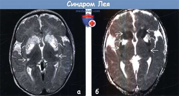 Синдром Лея на МРТ головного мозга