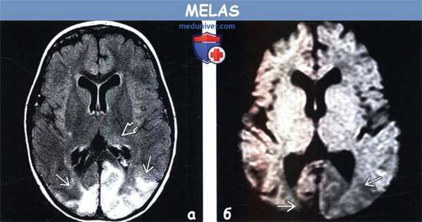 MELAS на МРТ головного мозга