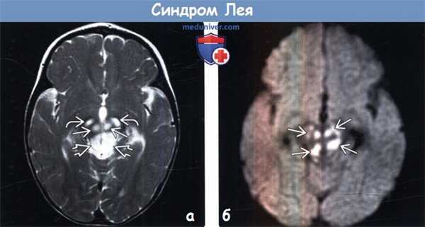 Синдром Лея на МРТ головного мозга