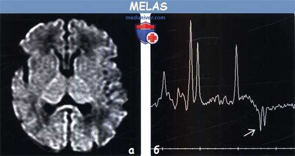 MELAS на МРТ головного мозга