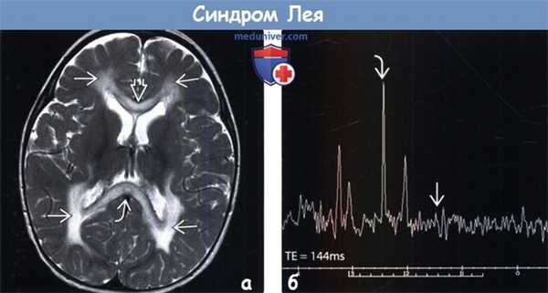 Синдром Лея на МРТ головного мозга