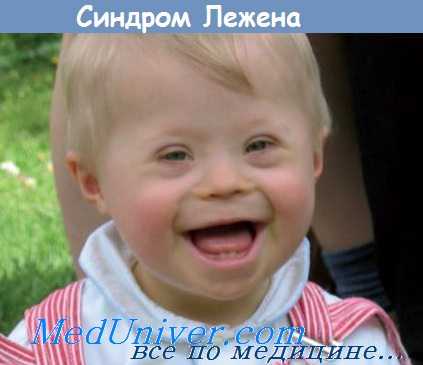 синдром лежена