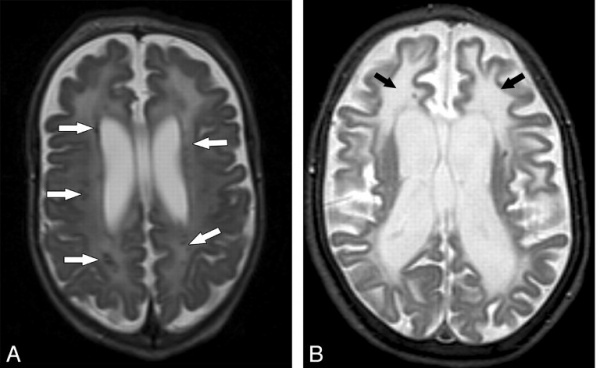 МРТ головного мозга при синдроме Айкарди