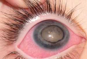 Болезнь Гиппеля-Линдау