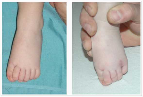 шесть пальцев