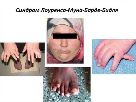 синдром лоренса