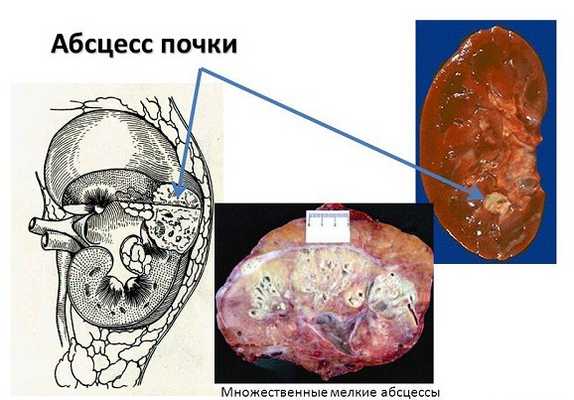 абсцесс почки