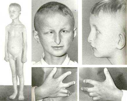 синдром лоуренса