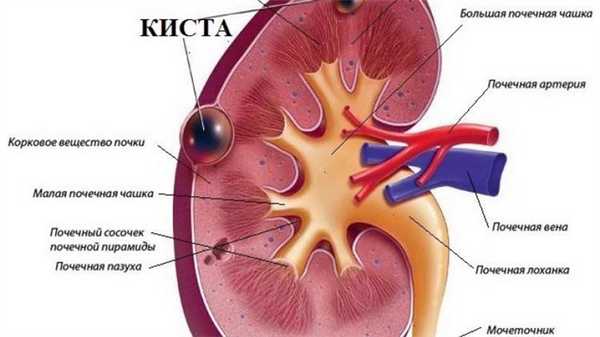 киста в почке